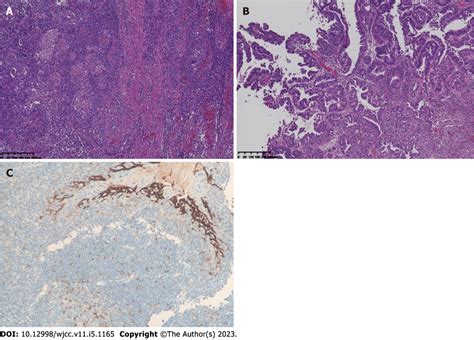 Histology of the tumor tissue before treatment. A and B: Representative ...