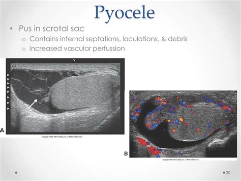 PPT - Scrotal Ultrasound PowerPoint Presentation, free download - ID ...