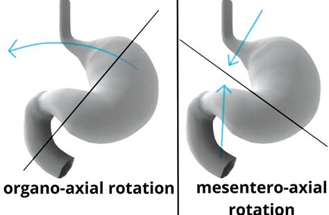 Cureus | Acute Gastric Volvulus in the Setting of a Paraesophageal Hernia With Hemoperitoneum ...