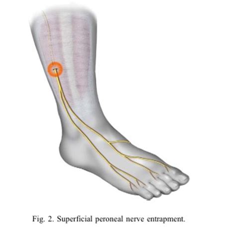 Foot Pain Due to A Nerve Entrapment - Gray Chiropractic St.Catharines ...