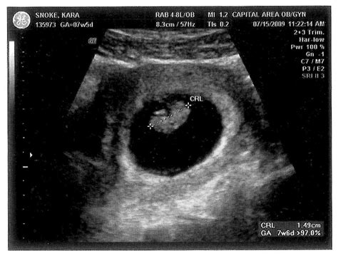 Baby Besido: 7 weeks 4 days ultrasound