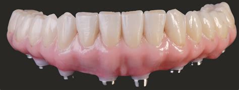 TLZ All Zirconia Crowns & Bridges: Expanded Uses Of Zirconia