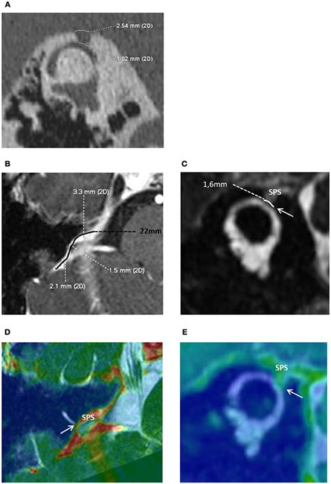 Frontiers | Stenting the Superior Petrosal Sinus in a Patient With Symptomatic Superior ...