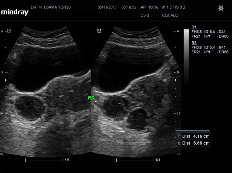 Haemorrhagic ovarian cyst | Image | Radiopaedia.org