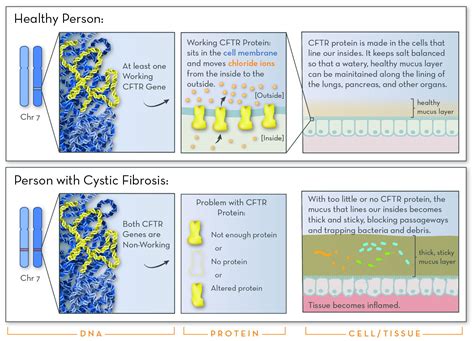 Cystic Fibrosis