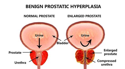 Diagram Of Enlarged Prostate