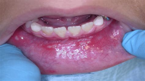 Herpetic stomatitis: Types, Symptoms and Outcome | Health Digest