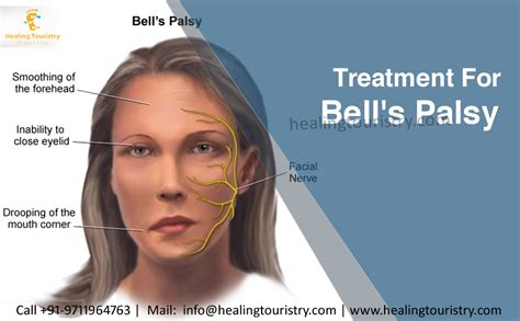 Healing Touristry: Bell's palsy – Symptoms, Causes and Treatment – Healing Touristry