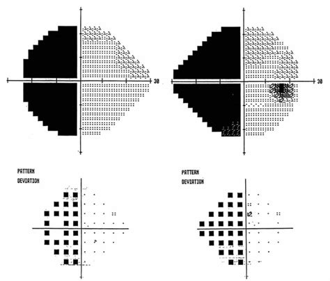 Approach to the Patient with Visual Loss | Neupsy Key