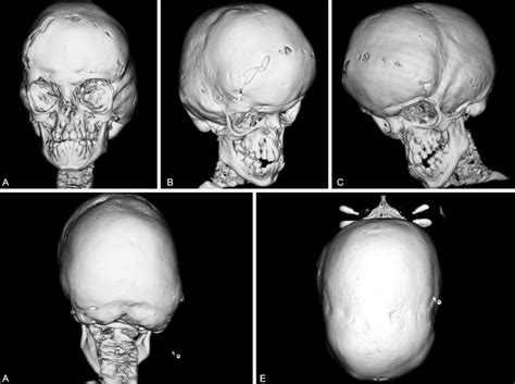 Crouzon Syndrome - Symptoms and Background