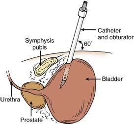 Suprapubic Urinary Catheter