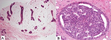 -A, Fibroadenoma: biopsy with a well-defined mass of connective tissue ...