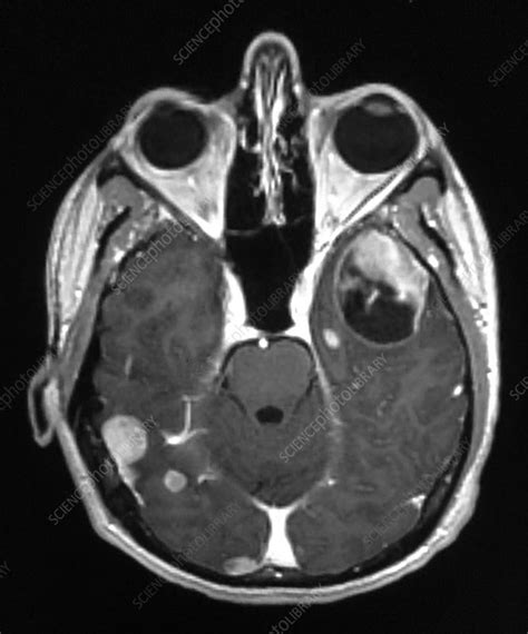 Melanoma Metastatic to Brain, MRI - Stock Image - C039/4205 - Science Photo Library