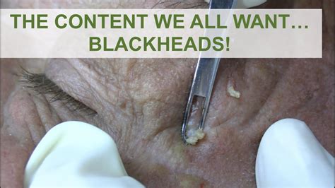 Blackheads from Sun Exposure - Pop That Zit - Since 2006!