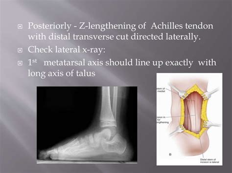 Congenital vertical talus