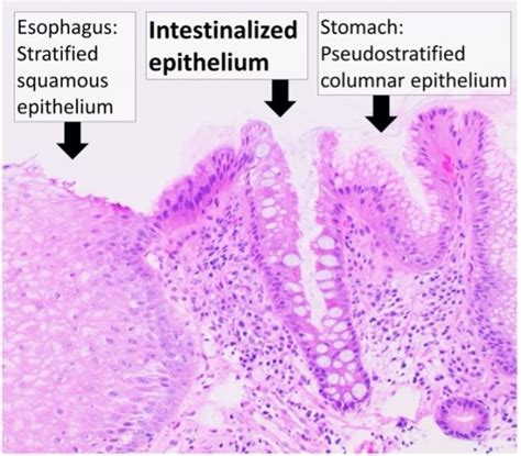 Barrett’s Oesophagus | Pathophysiology | Geeky Medics