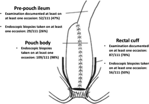 PWE-052 Current practices in ileal pouch surveillance for ulcerative ...