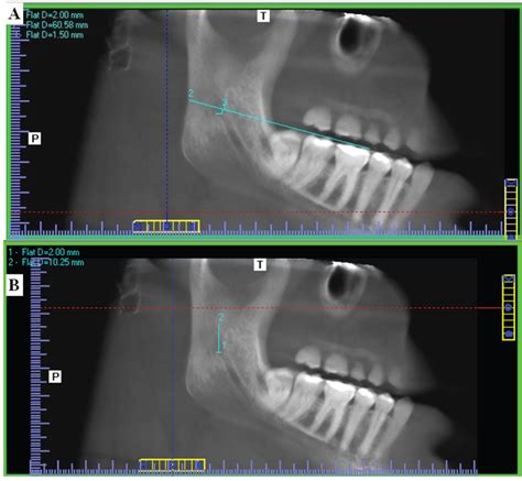 Mandibular Foramen Radiograph