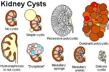 Types Of Kidney Cysts Renal Cysts Diagnosis And Treatment