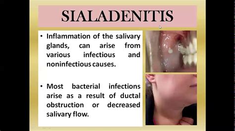 Salivary gland disease part 2 - YouTube