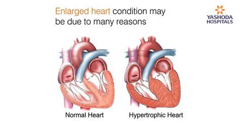 Enlarged Heart: What are its causes?