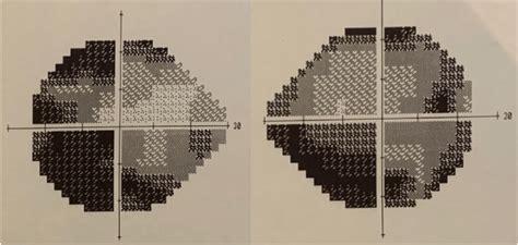 Bitemporal hemianopsia on an automated 24-2 visual field in Case 1.... | Download Scientific Diagram