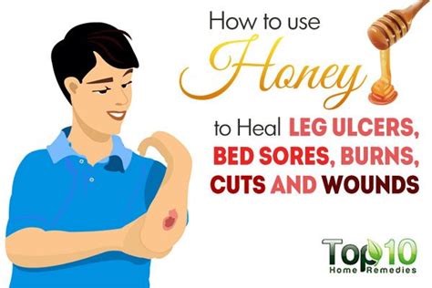 How to Use Honey to Heal Leg Ulcers, Bed Sores, Burns, Cuts and Wounds ...