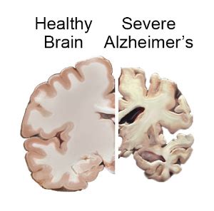 Alzheimer's Disease Fact Sheet | National Institute on Aging