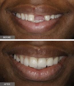 Front Tooth Implant (Top Rated NYC Dentist) - Midtown & Upper East Side