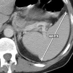 CT scan of the spleen showing normal dimension (11 cm) | Download ...