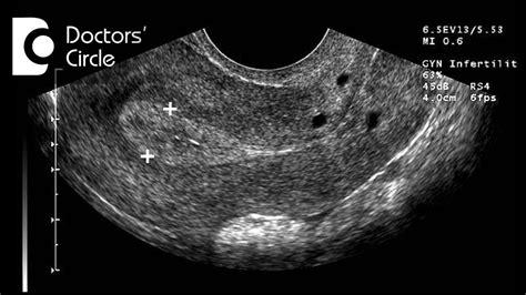 Is pregnancy possible with normal endometrial lining in... | Doovi