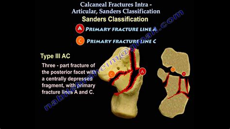 Calcaneal Intra-Articular Fractures, Sanders - Everything You Need To Know - Dr. Nabil Ebraheim ...