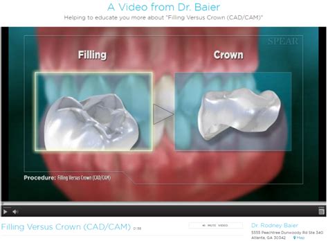 Dental Crown vs. Filling – RodneyBaierDDS