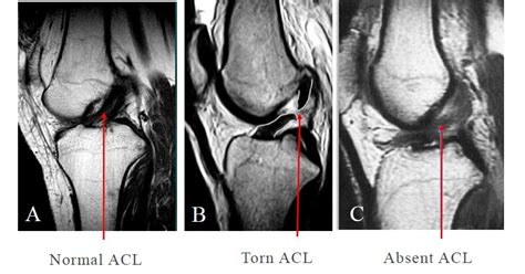 ACL, Anterior Cruciate Ligament Tear Treatment & surgery in Chennai