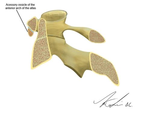 Accessory ossicle of the anterior arch of the atlas | Radiology Case | Radiopaedia.org | Medical ...