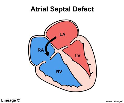 Atrial Septal Defect (ASD) - Cardiovascular - Medbullets Step 2/3