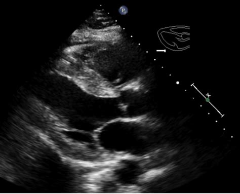 Paradoxical Left Ventricular Hypertrophy by Echocardiogram and Low Voltage ECG: A Key Clue in ...