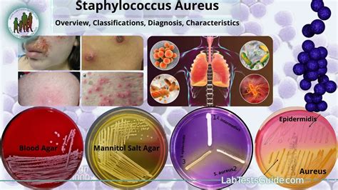 Staphylococcus Aureus: Overview, Symptoms, Causes, Diagnosis and Prevention