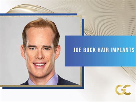 Joe Buck Hair Implants - Gold City Best Hair Transplant Turkey