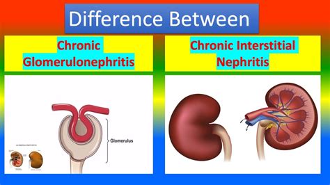 Difference Between Chronic Glomerulonephritis and. Chronic Interstitial Nephritis - YouTube