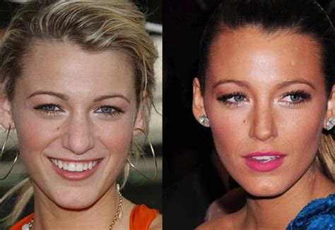 Blake Lively Nose Job Before And After