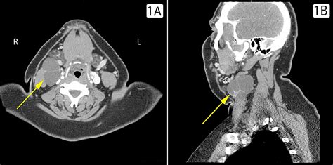 Cureus | Branchial Cleft Cyst Harbors Metastatic Papillary Thyroid ...