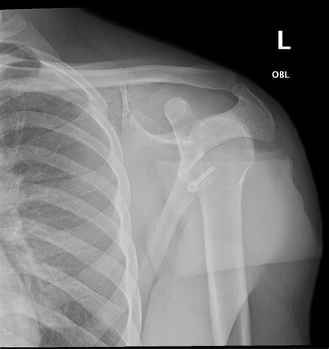 Latarjet Procedure - Dr. Mohamed Attia, M.D. PhD