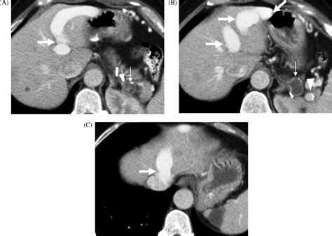 Congenital portosystemic shunts: Imaging findings and clinical ...