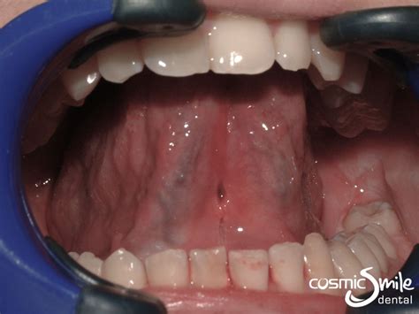 Frenectomy Before and After - Cosmic Smile Laser Dental