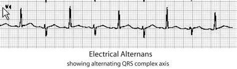 Electrical Alternans - Stepwards