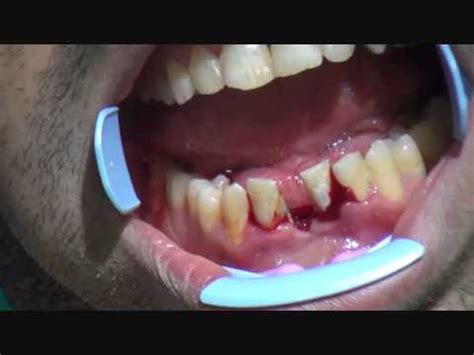 laser assisted periodontal treatment - YouTube