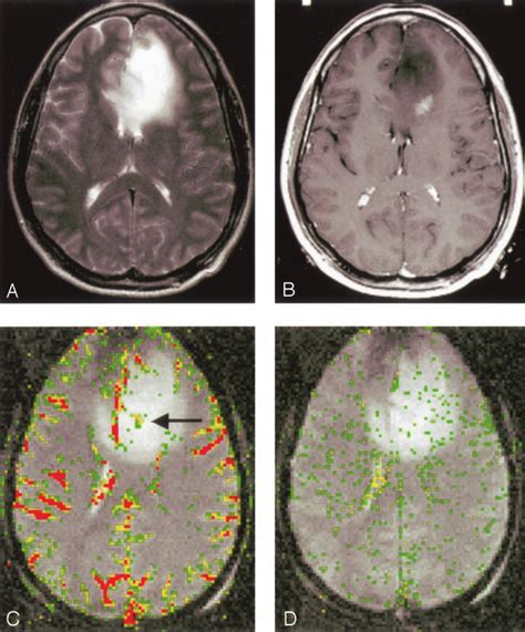 Low-grade astrocytoma (grade I/III). A, T2-weighted image (3158/119)... | Download Scientific ...