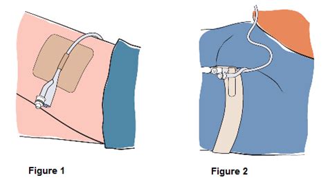 Caring for your catheter