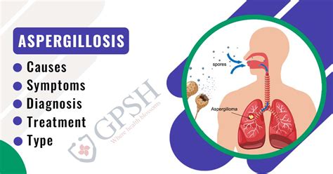 Aspergillosis: Types, Causes, Symptoms, Diagnosis & Treatment